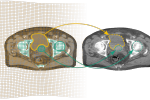 Links CT (Bestrahlungsplan), rechts CBCT-Aufnahme kurz vor der Bestrahlung; nach der Registrierung können Objekte des Bestrahlungsplans automatisch im CBCT erkannt werden.